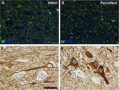 Acute Neurofilament Light Chain Plasma Levels Correlate With Stroke Severity and Clinical Outcome in Ischemic Stroke Patients